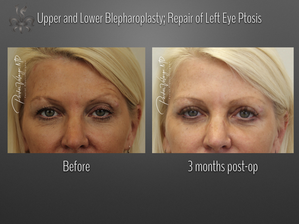 Blepharoplasty (Eyelid Surgery) before and after