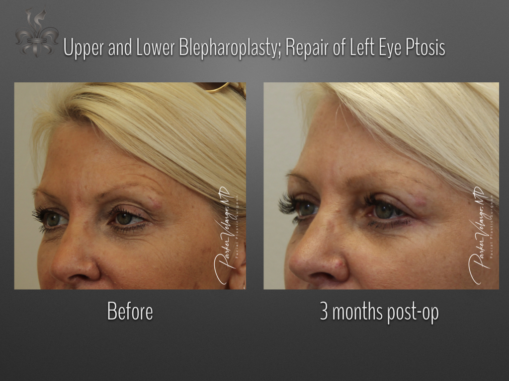 Blepharoplasty (Eyelid Surgery) before and after