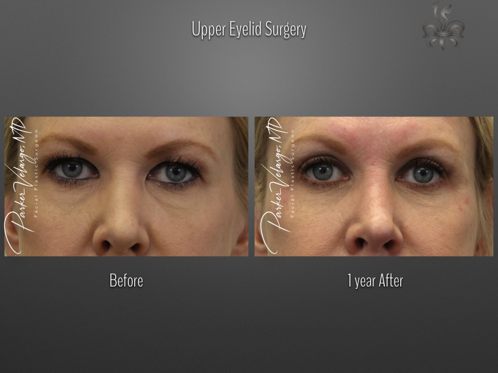 Blepharoplasty (Eyelid Surgery) before and after
