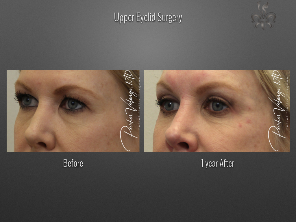 Blepharoplasty (Eyelid Surgery) before and after