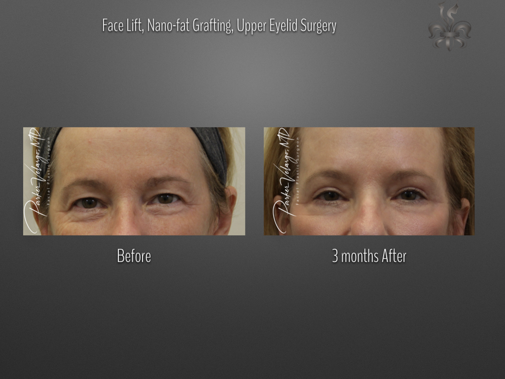 Blepharoplasty (Eyelid Surgery) before and after