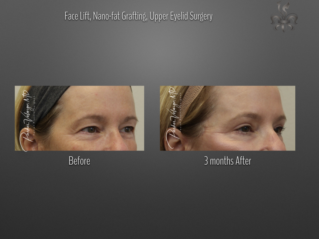 Blepharoplasty (Eyelid Surgery) before and after