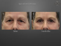 Blepharoplasty (Eyelid Surgery) before and after