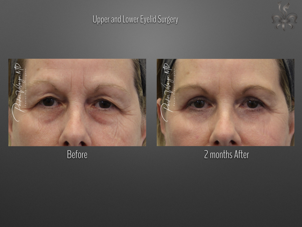 Blepharoplasty (Eyelid Surgery) before and after
