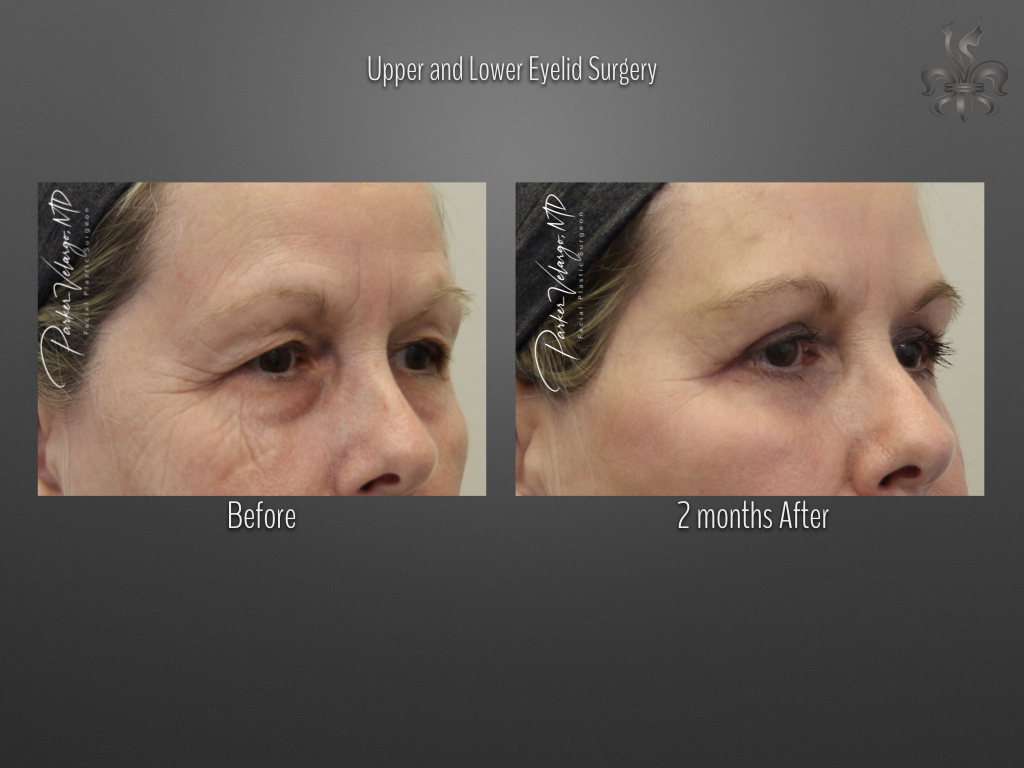 Blepharoplasty (Eyelid Surgery) before and after