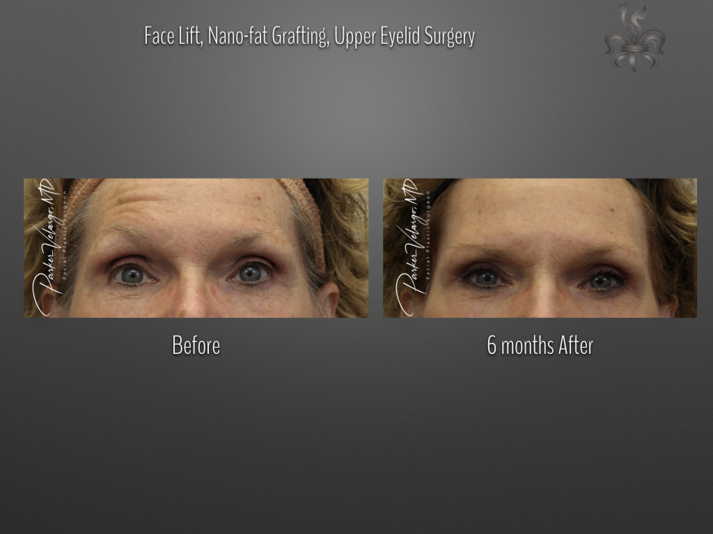 Blepharoplasty (Eyelid Surgery) before and after