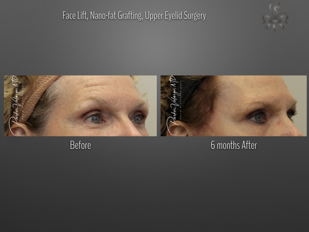 Blepharoplasty (Eyelid Surgery) before and after