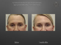 Blepharoplasty (Eyelid Surgery) before and after