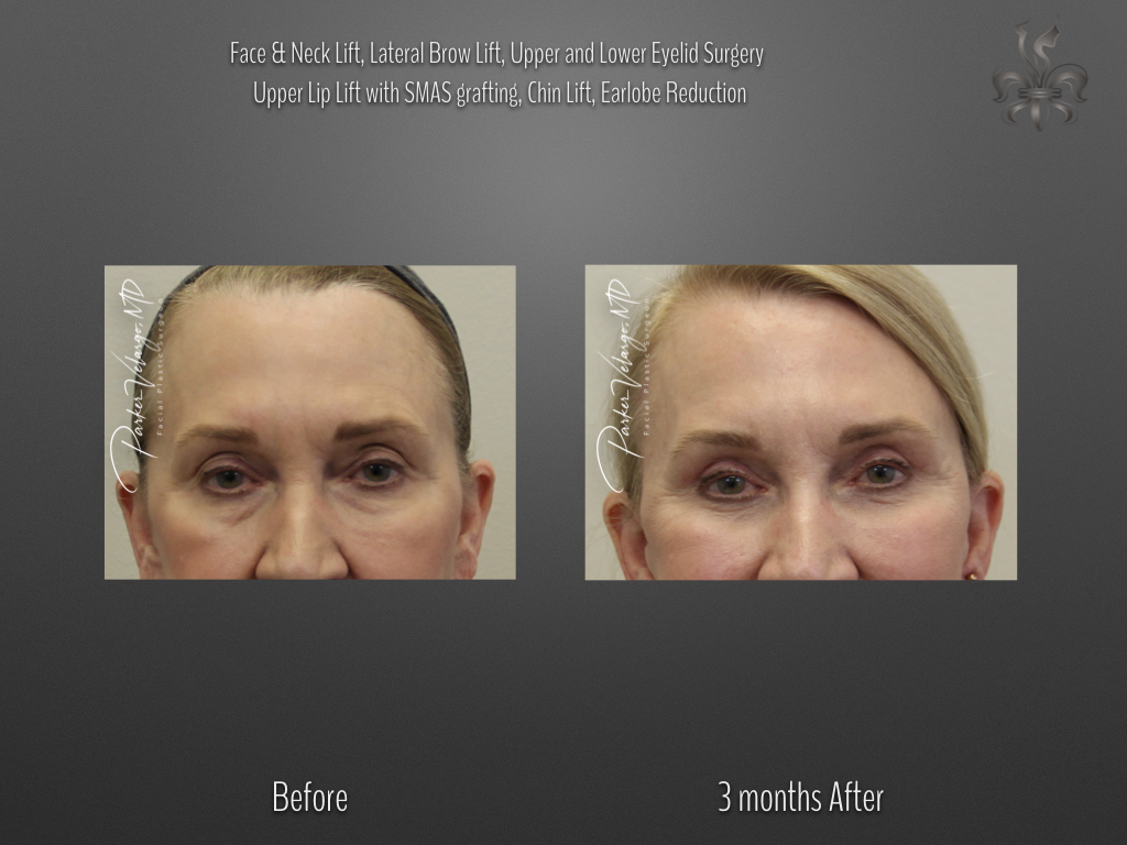 Blepharoplasty (Eyelid Surgery) before and after