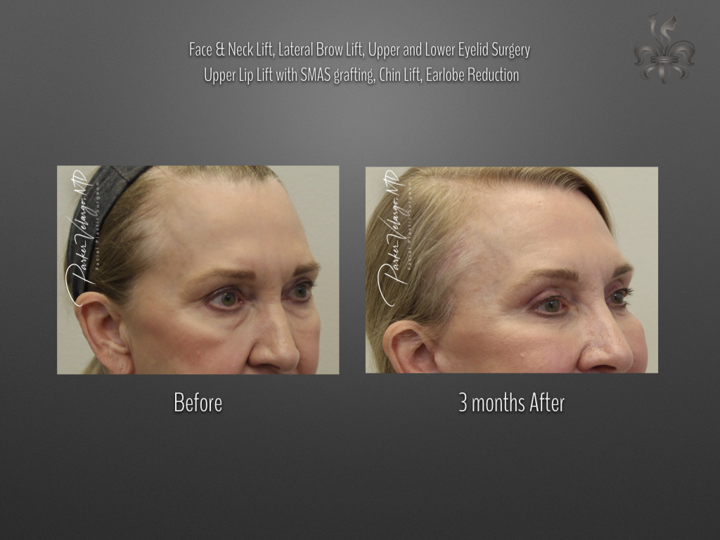 Blepharoplasty (Eyelid Surgery) before and after