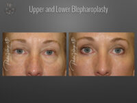 Blepharoplasty (Eyelid Surgery) before and after