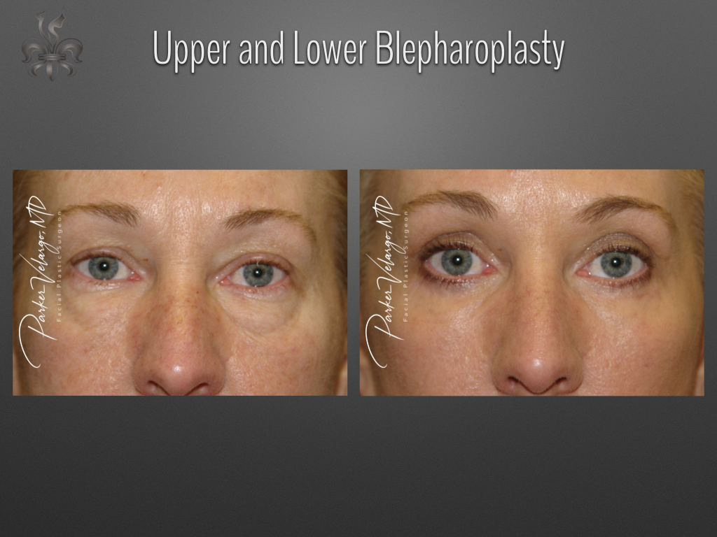 Blepharoplasty (Eyelid Surgery) before and after