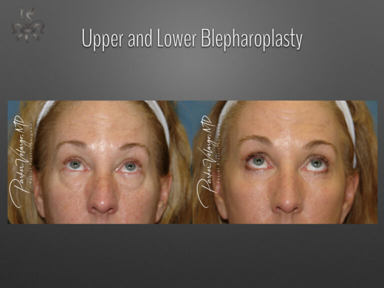 Blepharoplasty (Eyelid Surgery) before and after