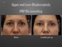 Blepharoplasty (Eyelid Surgery) before and after