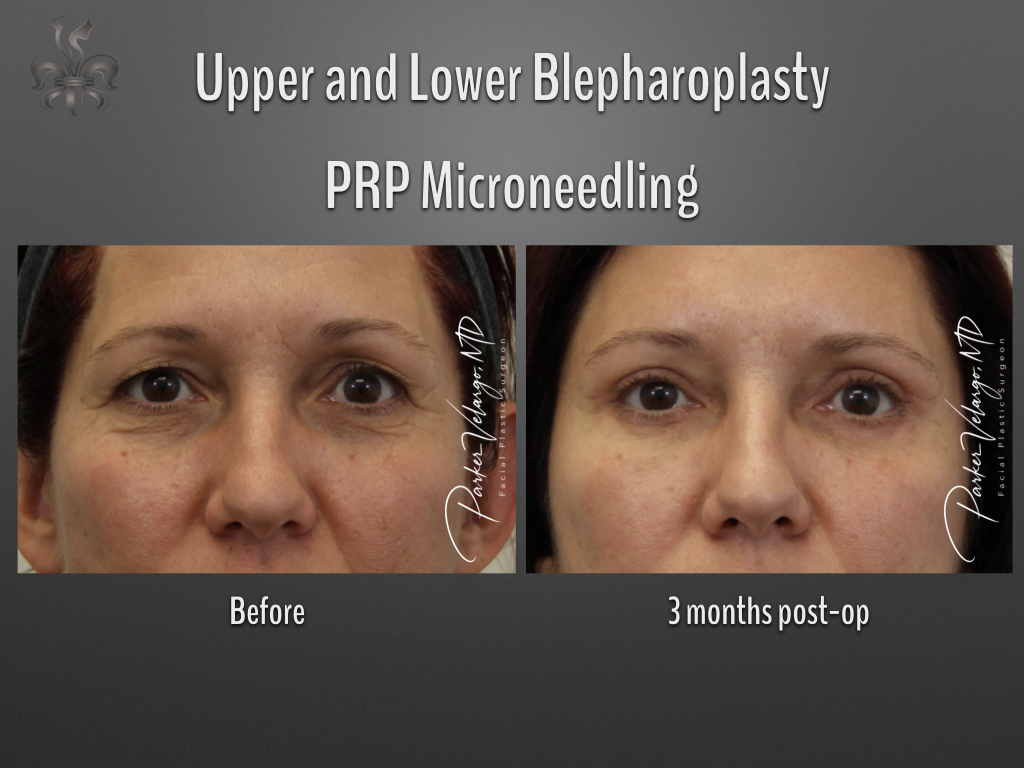 Blepharoplasty (Eyelid Surgery) before and after