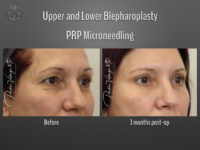 Blepharoplasty (Eyelid Surgery) before and after