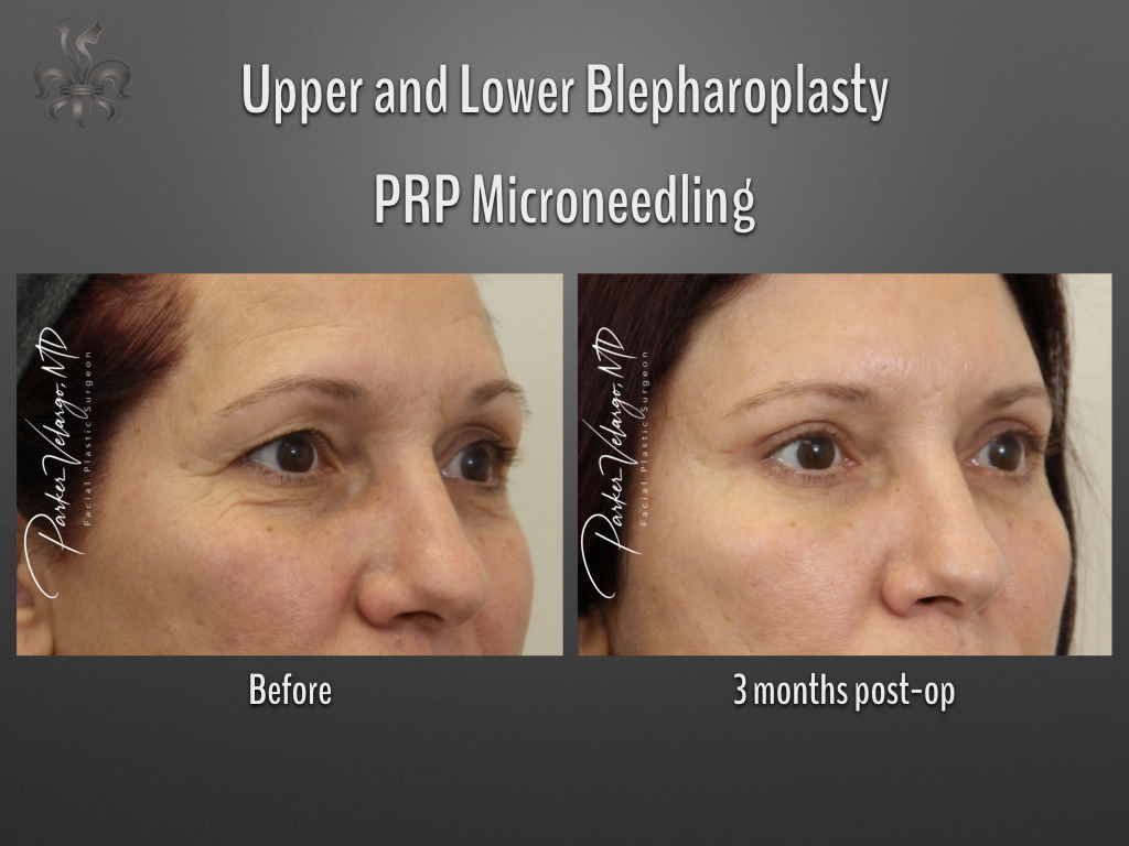 Blepharoplasty (Eyelid Surgery) before and after