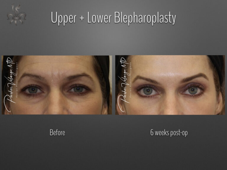 Blepharoplasty (Eyelid surgery) before and after