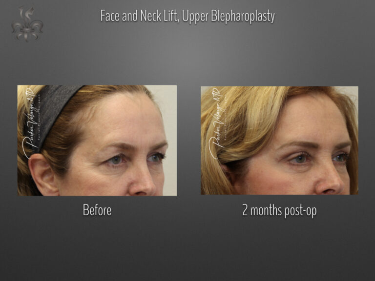 Blepharoplasty (Eyelid surgery) before and after