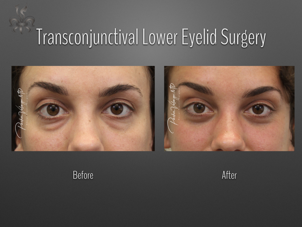 Blepharoplasty (Eyelid surgery) before and after