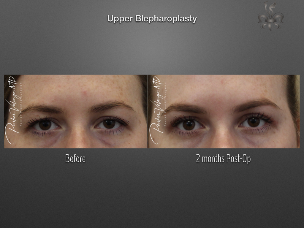Blepharoplasty (Eyelid surgery) before and after