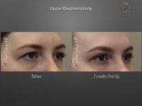 Blepharoplasty (Eyelid surgery) before and after