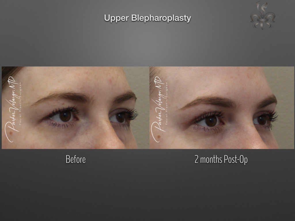 Blepharoplasty (Eyelid surgery) before and after