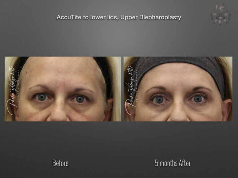 Blepharoplasty (Eyelid surgery) before and after