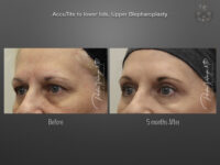 Blepharoplasty (Eyelid surgery) before and after