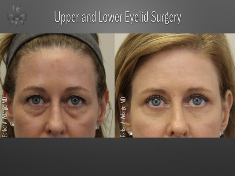 Blepharoplasty (Eyelid surgery) before and after