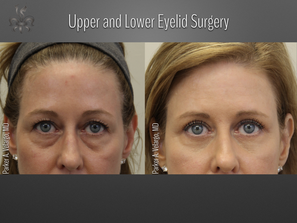 Blepharoplasty (Eyelid surgery) before and after