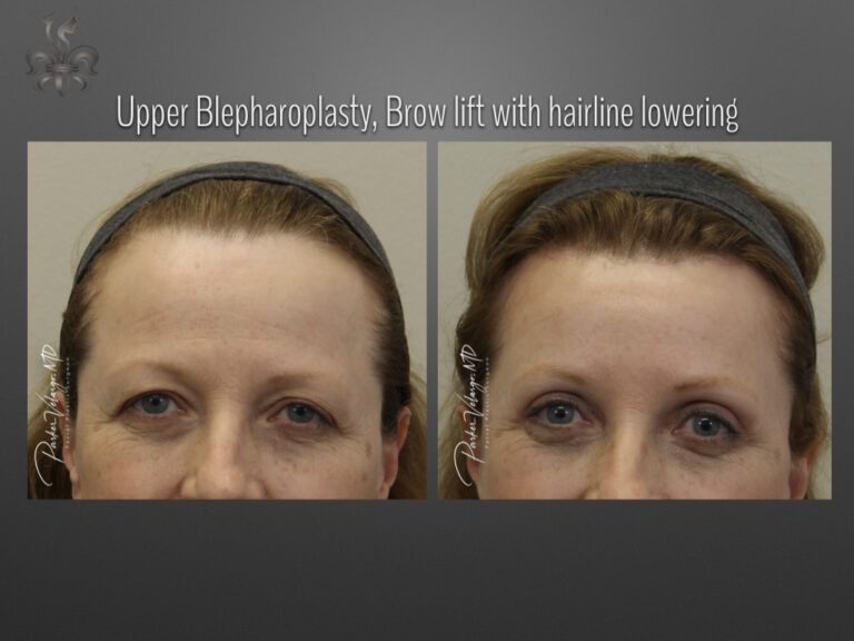 Blepharoplasty (Eyelid surgery) before and after