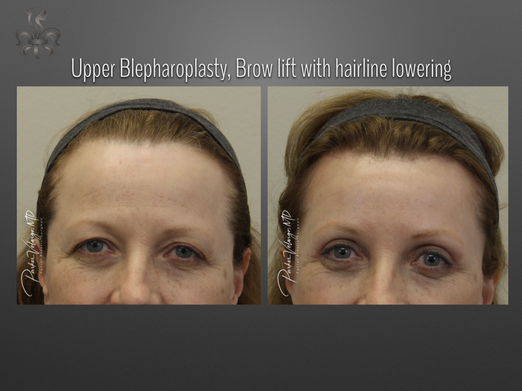 Blepharoplasty (Eyelid surgery) before and after