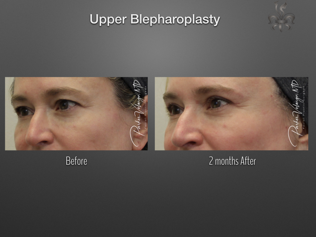 Blepharoplasty (Eyelid surgery) before and after