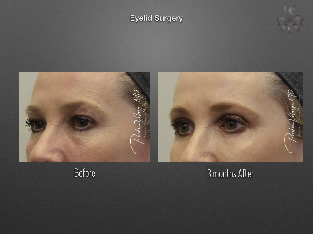 Blepharoplasty (Eyelid surgery) before and after