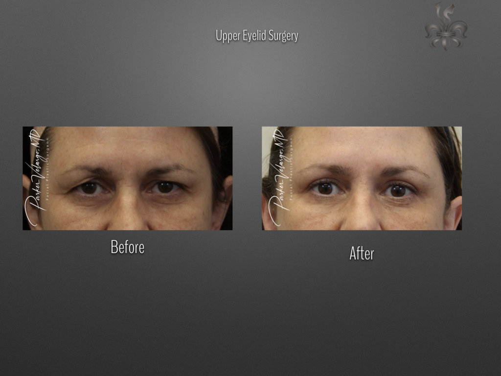 Blepharoplasty (Eyelid surgery) before and after