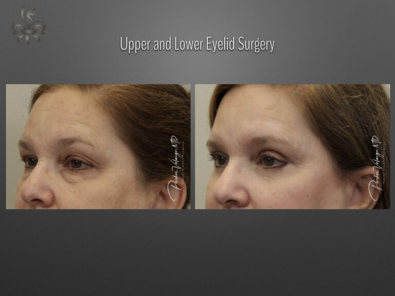 Blepharoplasty (Eyelid surgery) before and after