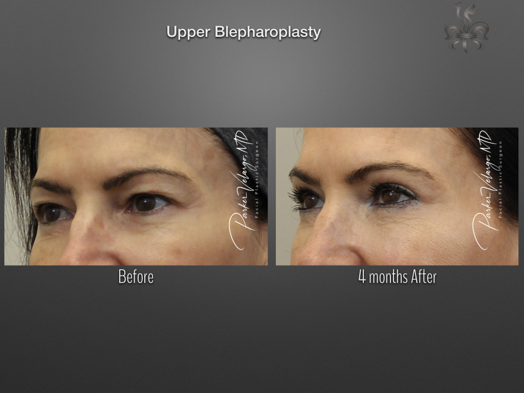 Blepharoplasty (Eyelid surgery) before and after