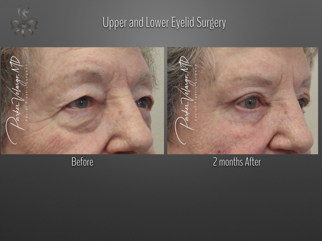 Blepharoplasty (Eyelid surgery) before and after