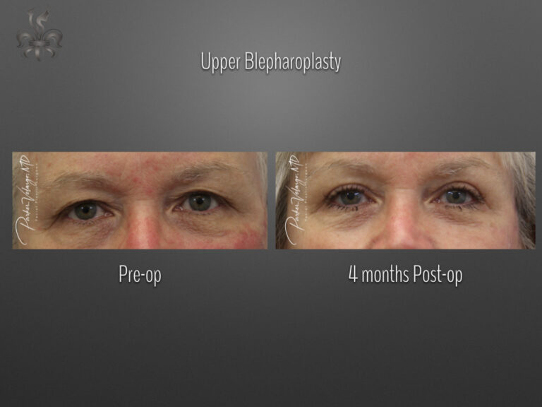 Blepharoplasty (Eyelid surgery) before and after