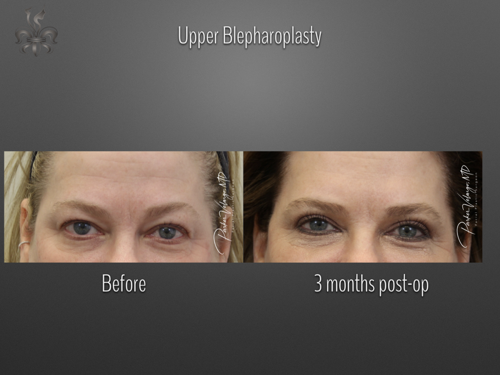 Blepharoplasty (Eyelid surgery) before and after