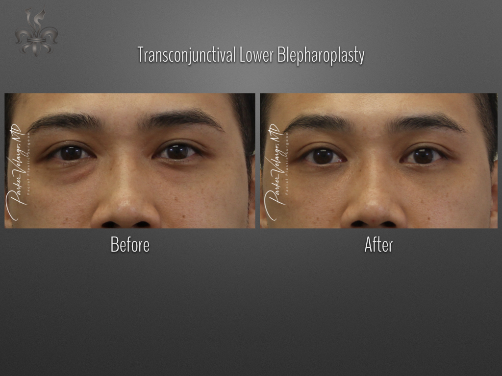 Blepharoplasty (Eyelid surgery) before and after