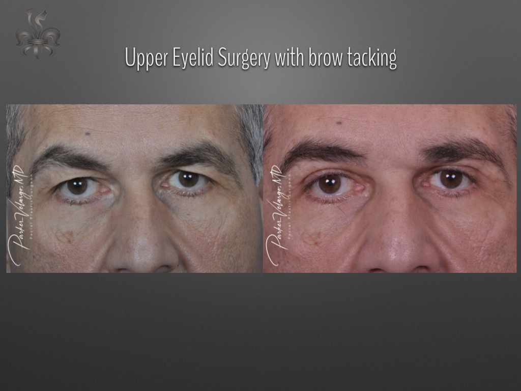Blepharoplasty (Eyelid surgery) before and after