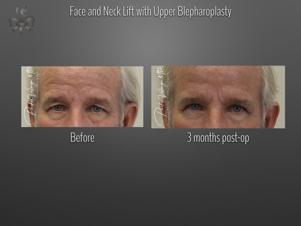 Blepharoplasty (Eyelid surgery) before and after