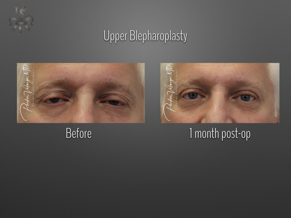 Blepharoplasty (Eyelid surgery) before and after