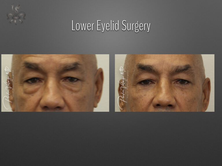 Blepharoplasty (Eyelid surgery) before and after