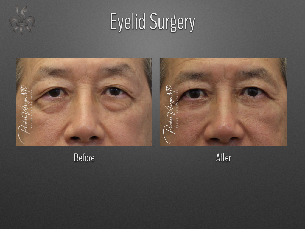 Blepharoplasty (Eyelid surgery) before and after