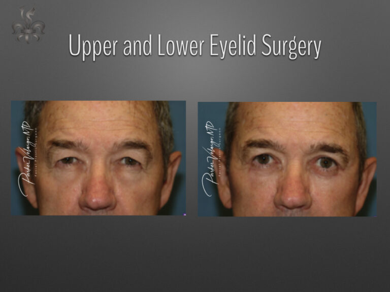 Blepharoplasty (Eyelid surgery) before and after