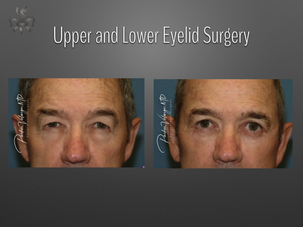 Blepharoplasty (Eyelid surgery) before and after