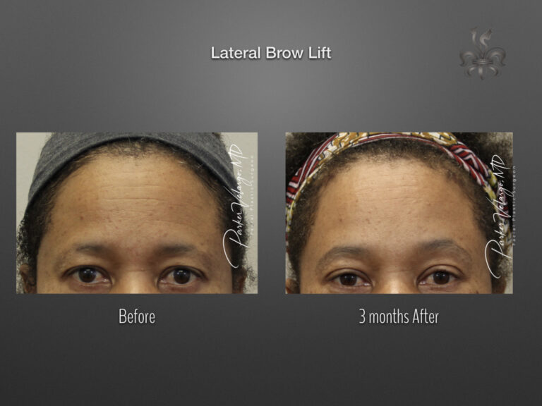 Brow Lift before and after